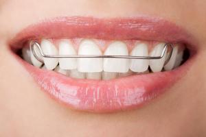 retainer-photo-of-front-teeth